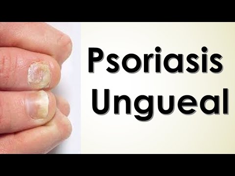 Adiós a los problemas de psoriasis ungueal y hongos: descubre el tratamiento definitivo